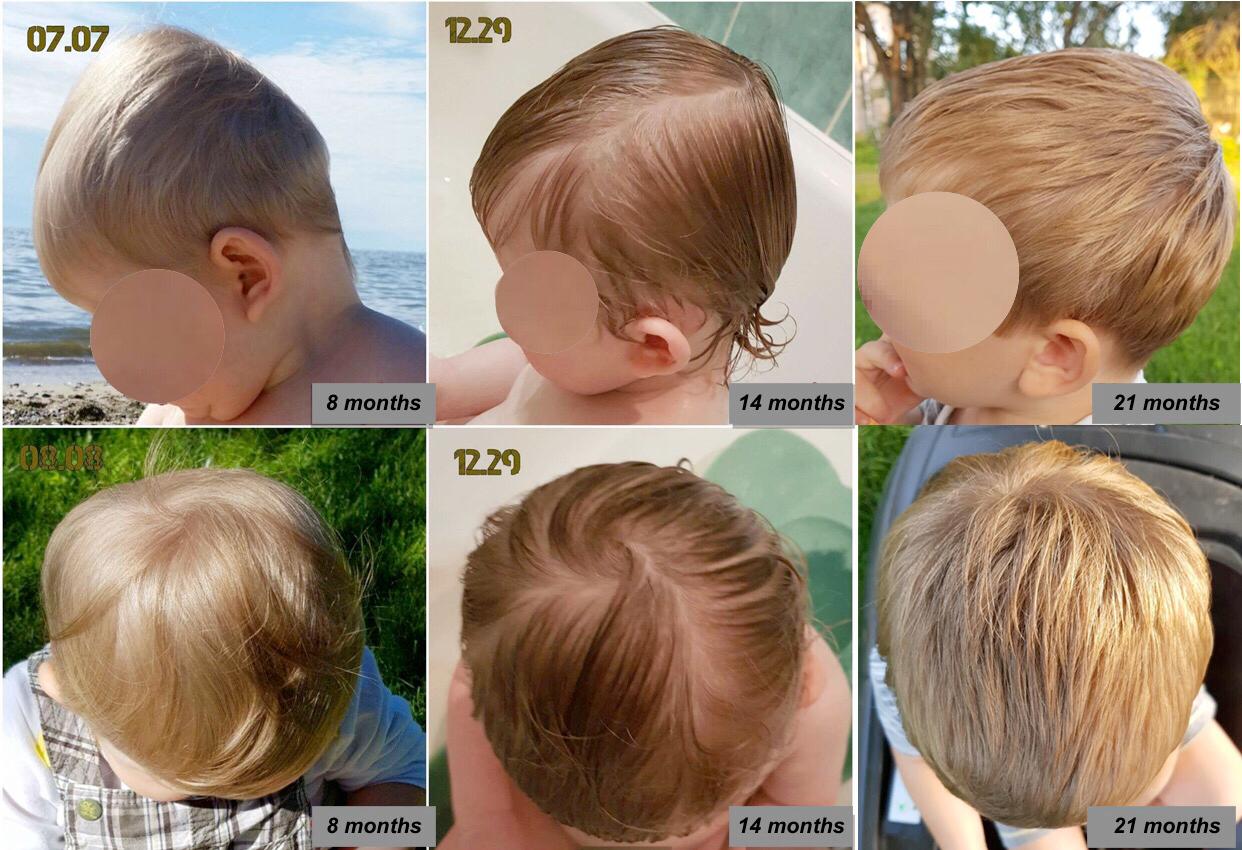plagiocephaly; plagiocephaly in infants; baby flat spot